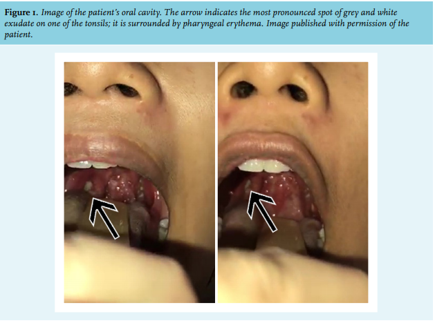 Diphtheria