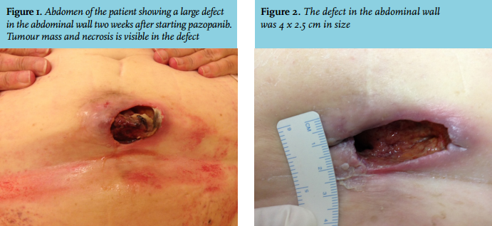 endometrial cancer in metastatic